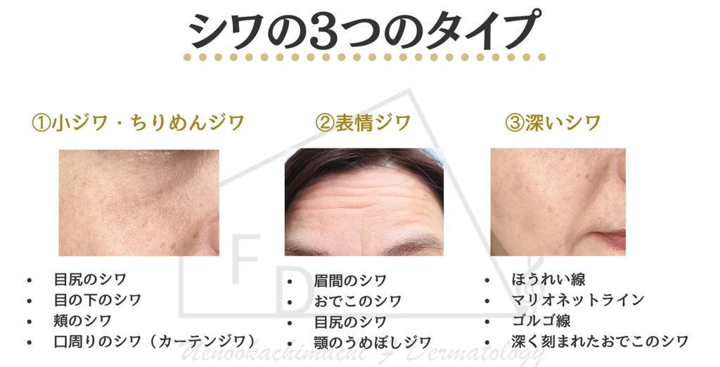 シワの3つのタイプについて