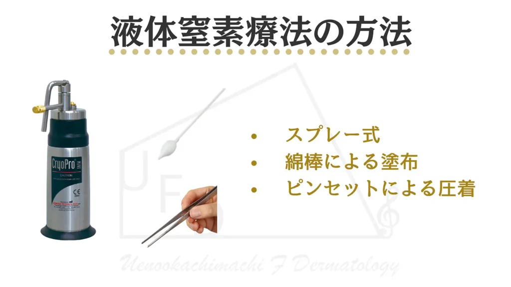 液体窒素療法の具体的な処置を説明した画像