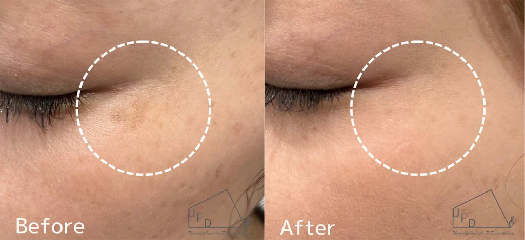 症例 30歳代女性 頬の肝斑 色素沈着