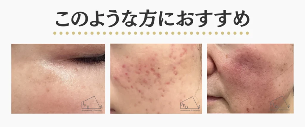 高濃度5％トラネキサム酸ローション治療に向いている症状を患部写真で紹介した画像