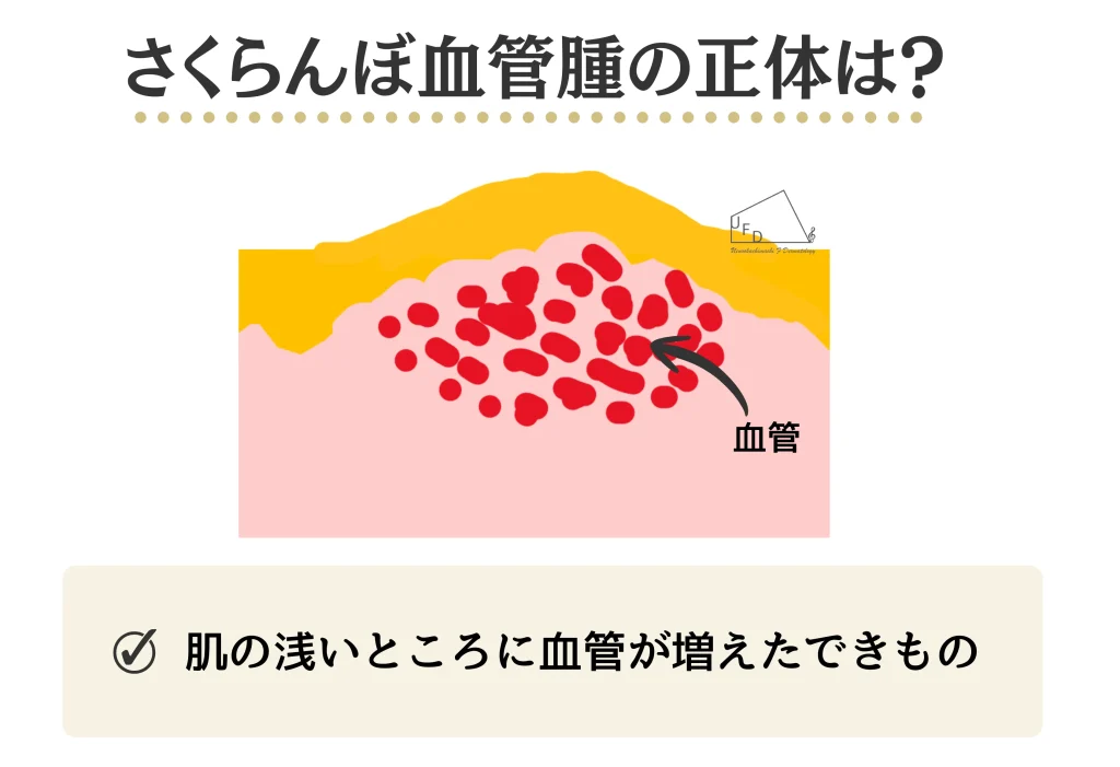 さくらんぼ血管腫の正体とは？