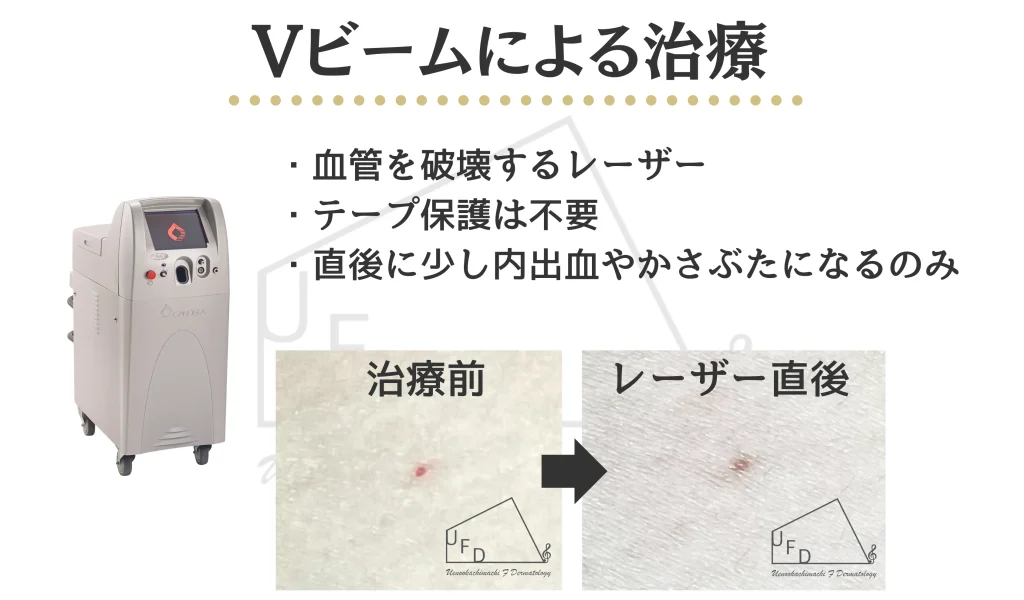 Vビームによるさくらんぼ血管腫の治療