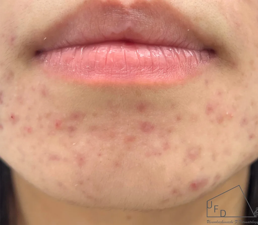 顎の赤みの患部の写真