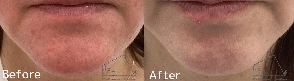 症例2 40歳代女性 顎の赤み Vビームレーザー5回