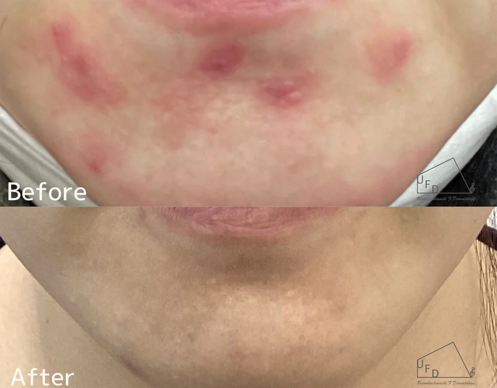 症例3 30歳代女性 口周りのニキビ、ニキビ跡の赤み改善 2回実施