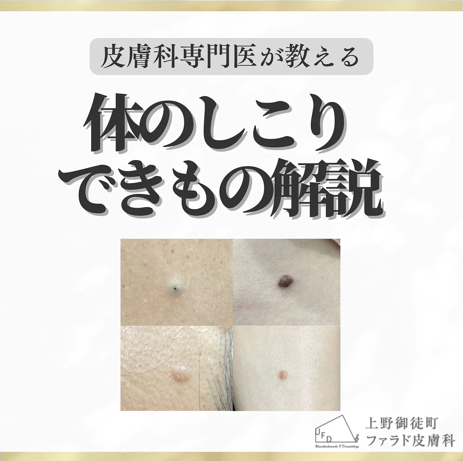 コラム 体のしこりできもの解説のアイキャッチ画像