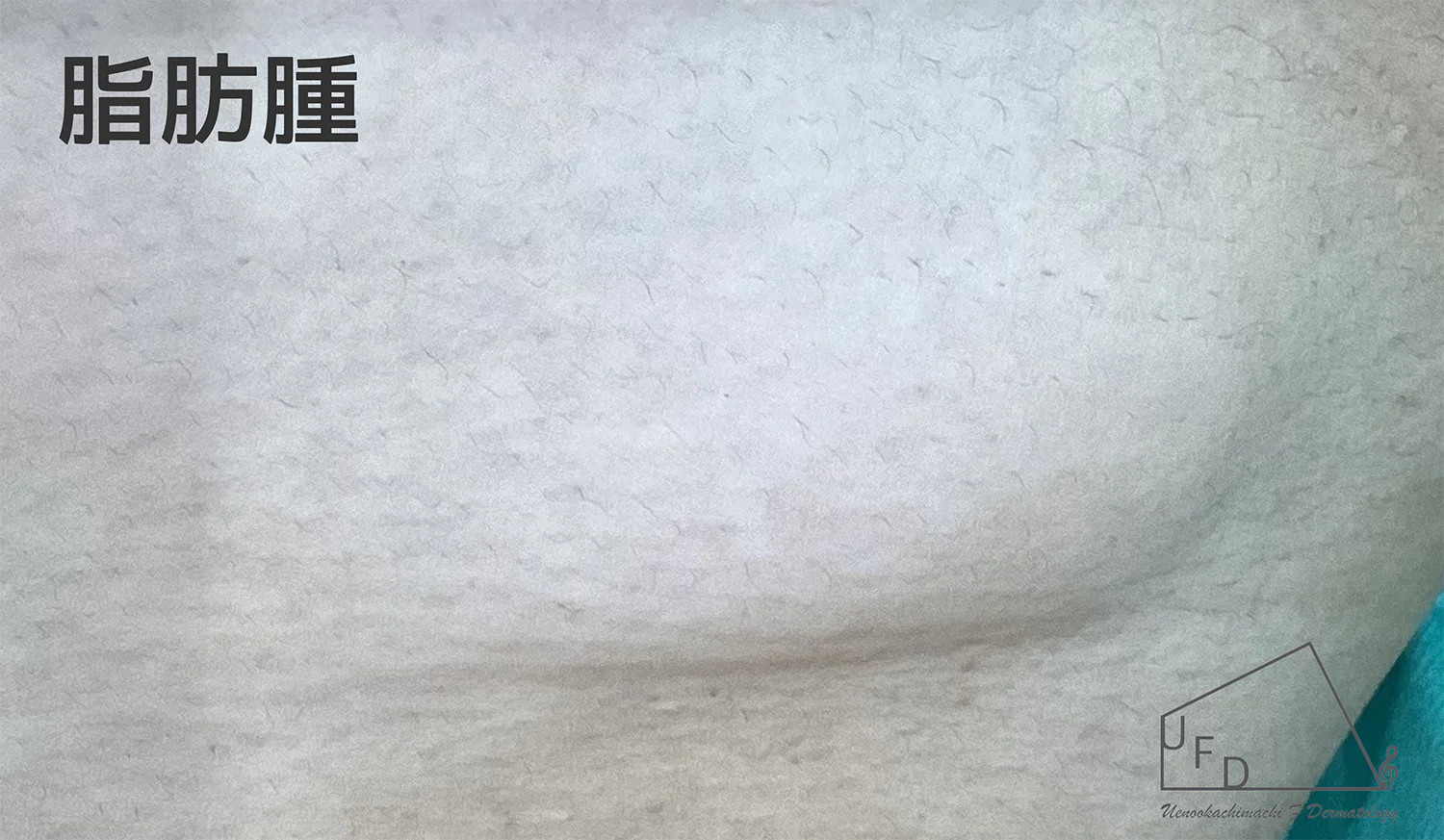 脂肪腫の患部写真