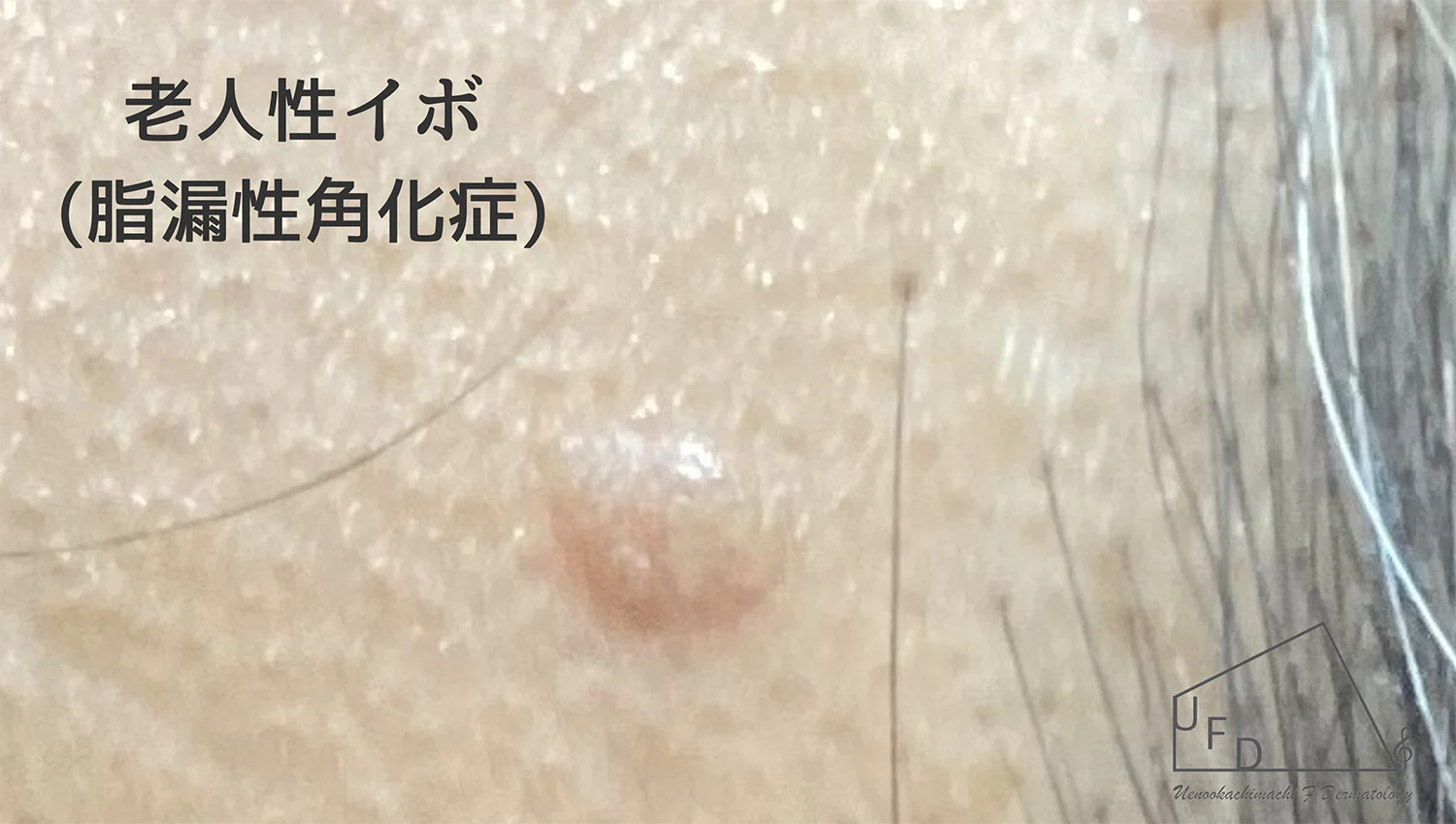老人性イボ 脂漏性角化症の患部写真