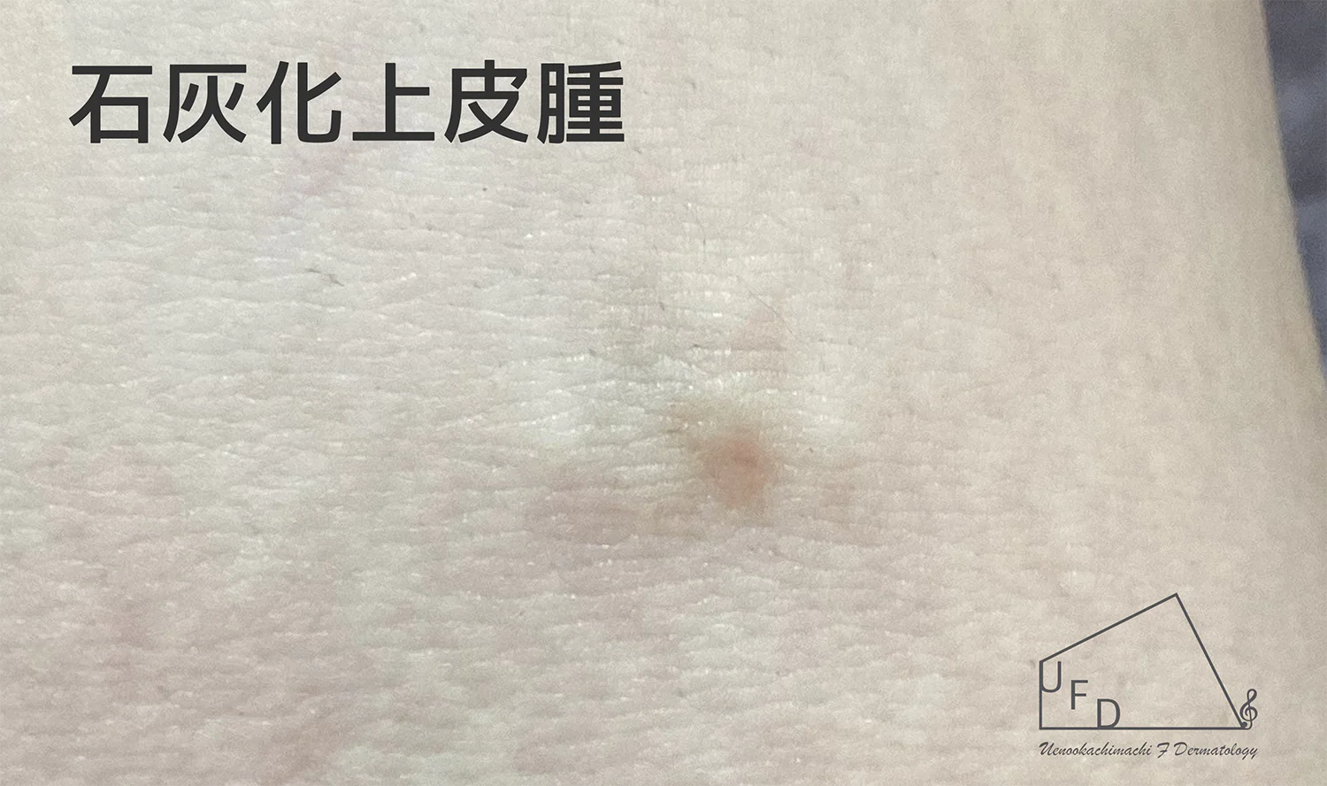 石灰化上皮腫 毛母腫の患部写真