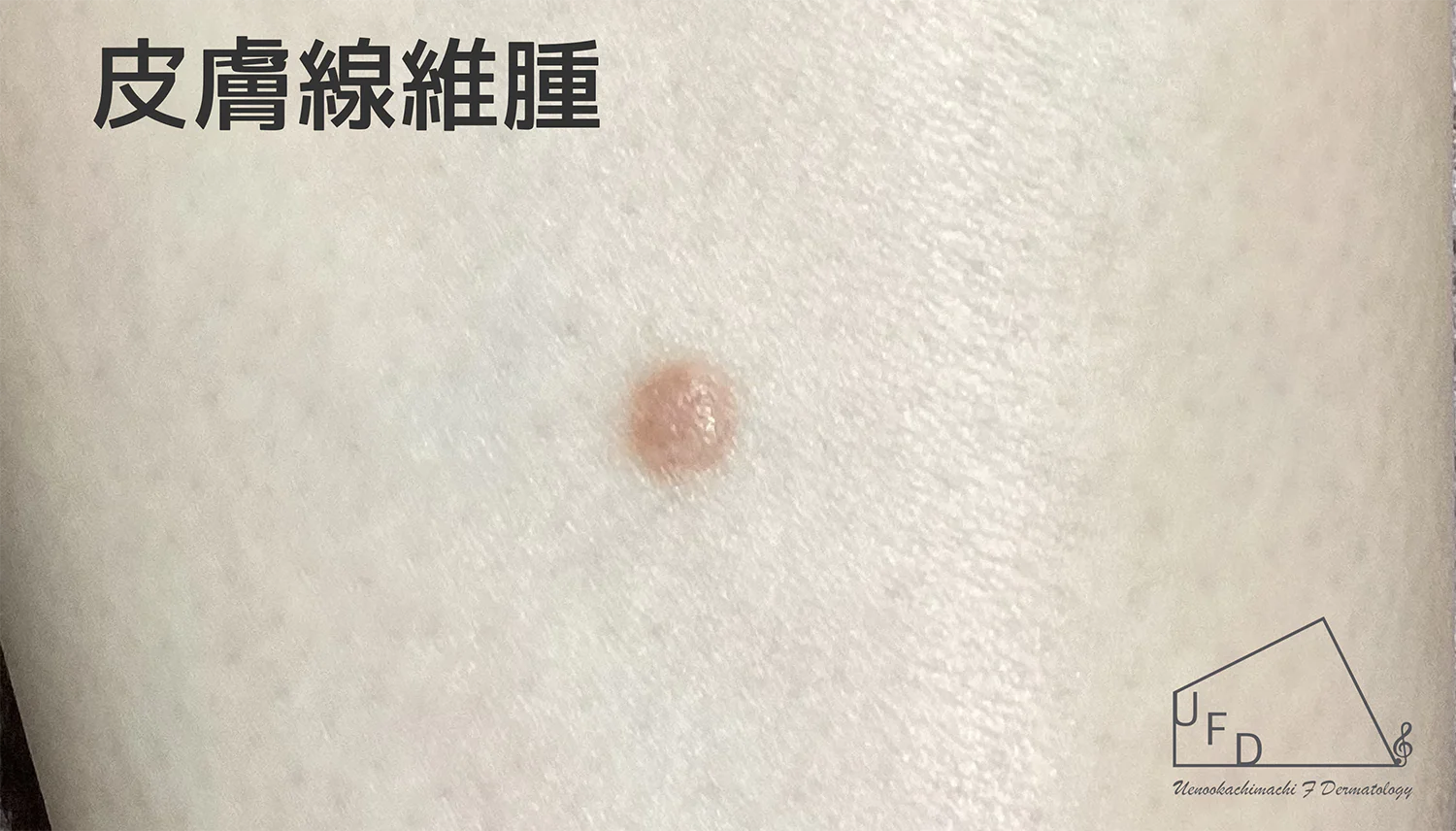 皮膚繊維腫の患部写真