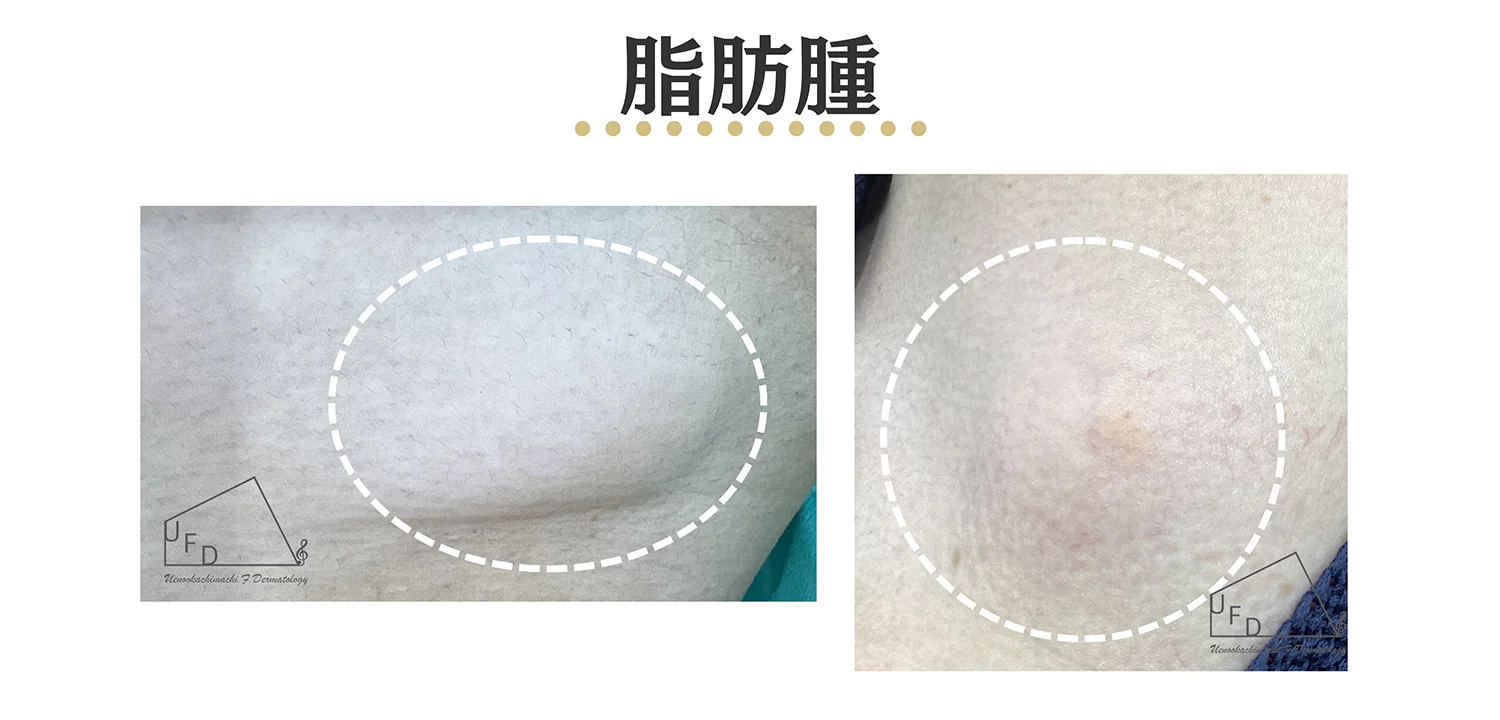 脂肪腫の患部写真