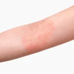 湿疹 かゆみの症状がある腕の写真