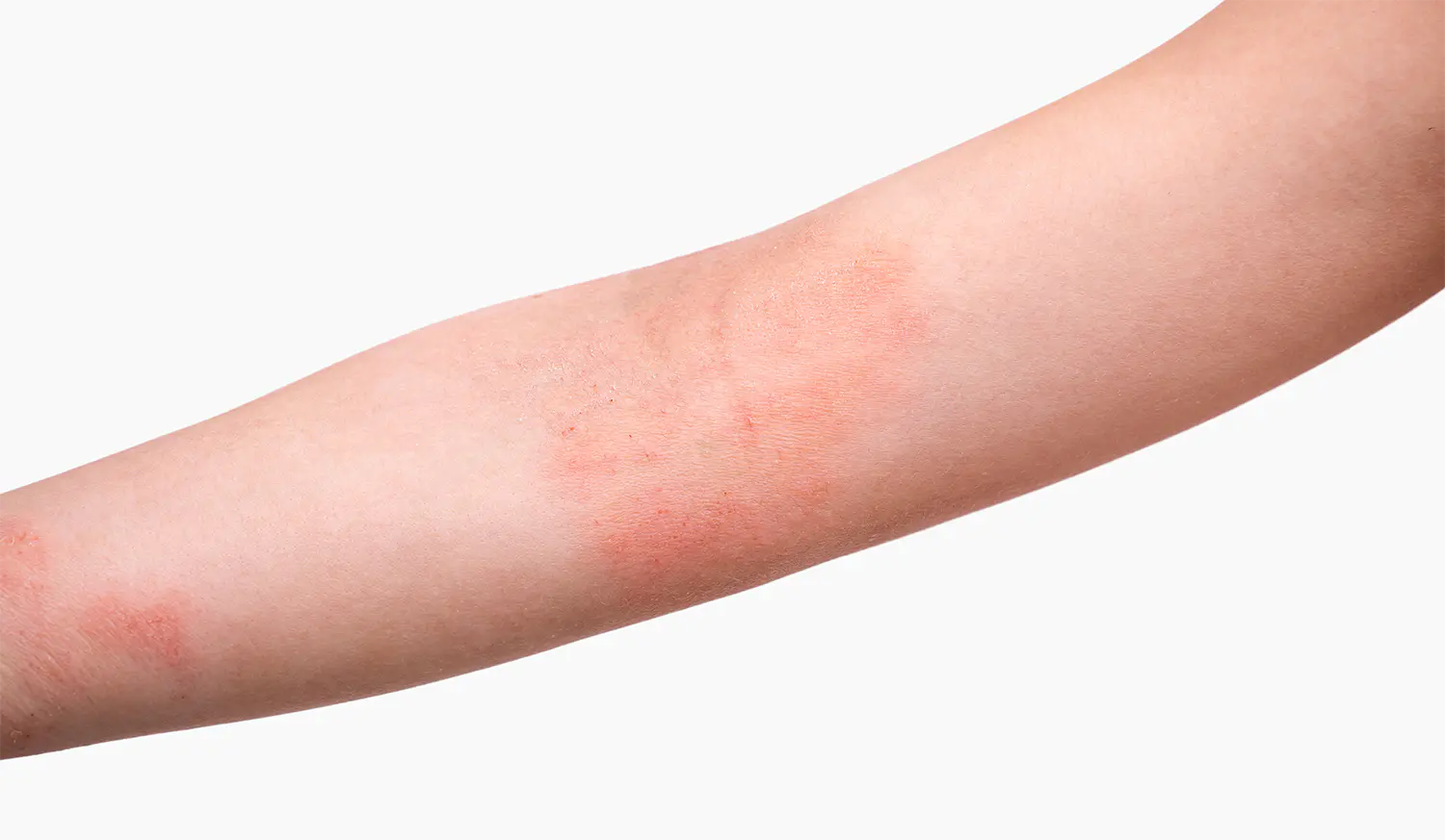 湿疹 かゆみの症状がある腕の写真