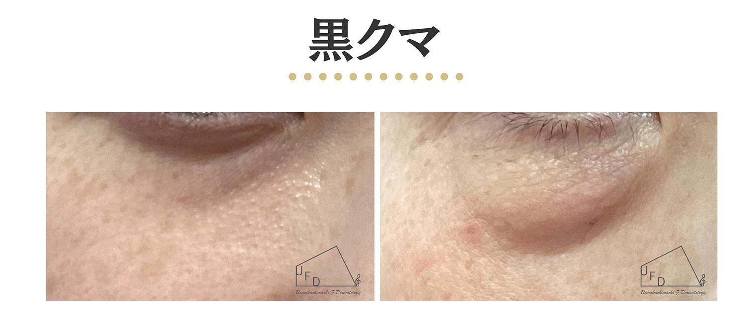 黒クマの患部写真