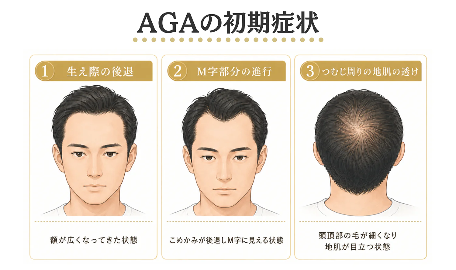 AGAの初期症状の図解