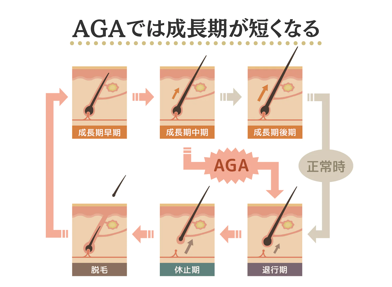 AGAの仕組みの図解