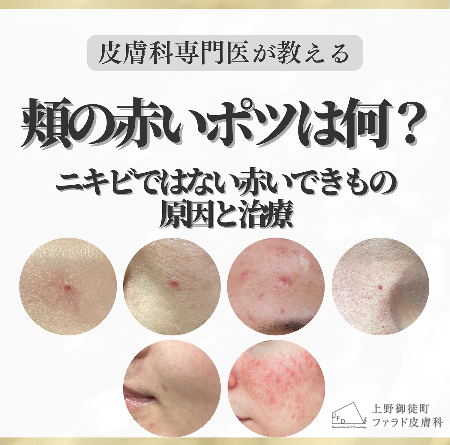 コラム 頬の赤いポツは何?ニキビではない赤いできものの原因と治療 のサムネイル