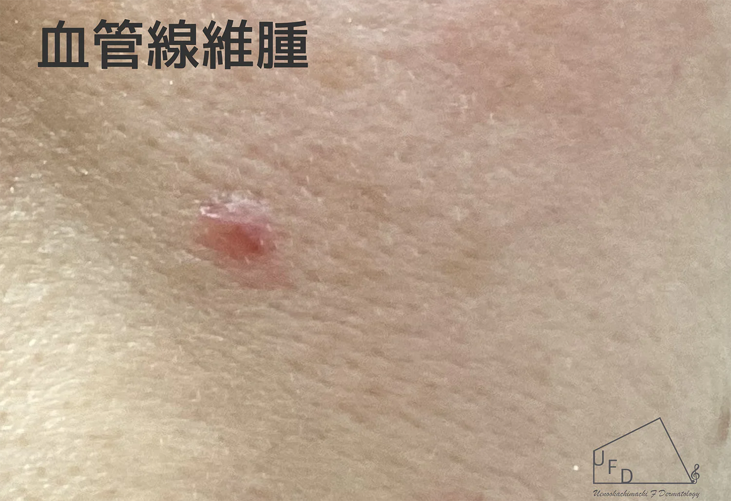 血管繊維腫の患部写真