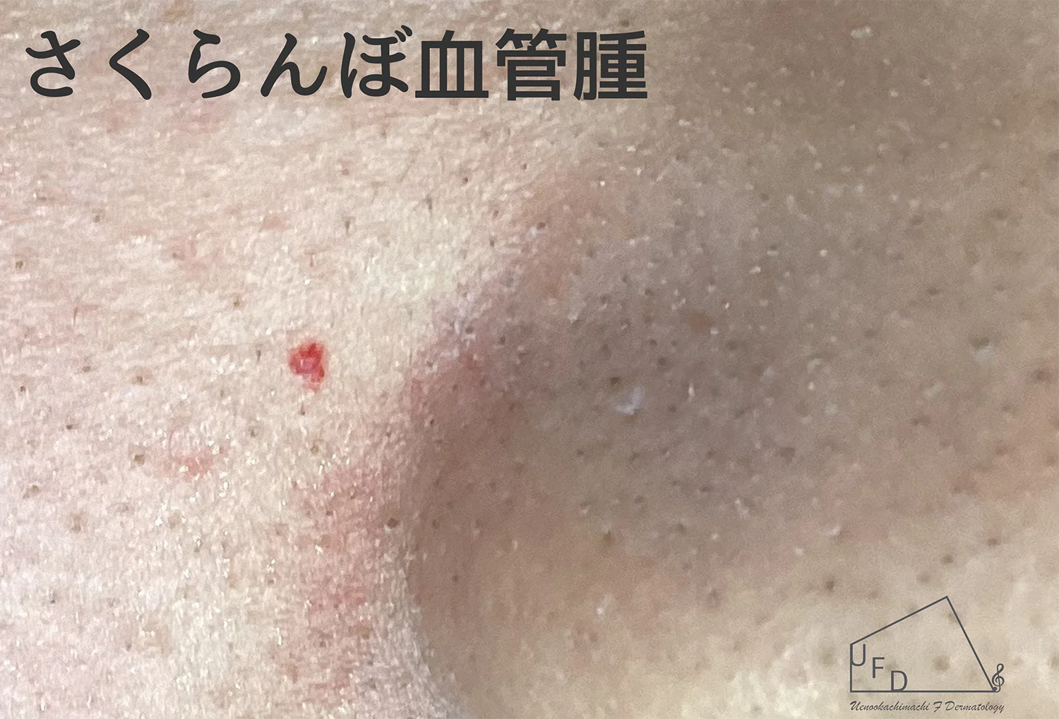 さくらんぼ血管腫の患部写真