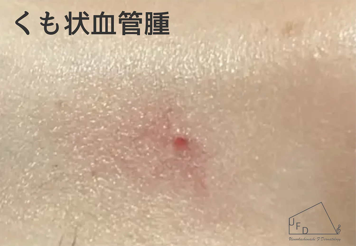 くも状血管腫の患部写真