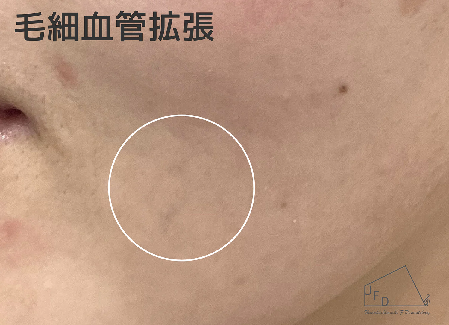 毛細血管拡張症の患部写真