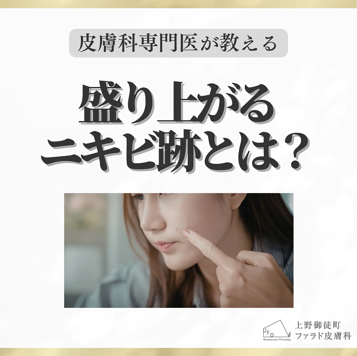 コラム 盛り上がるニキビ跡とは？しこり・ケロイド・肥厚性瘢痕の違いと皮膚科での治療法のサムネイル画像