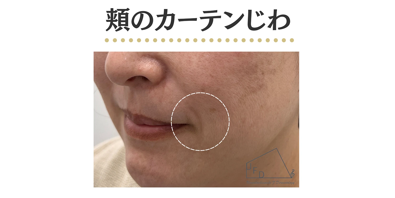 頬のカーテンジワの患部写真