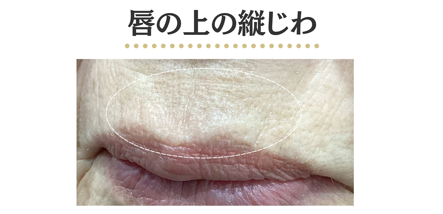 唇の上の縦ジワの患部写真