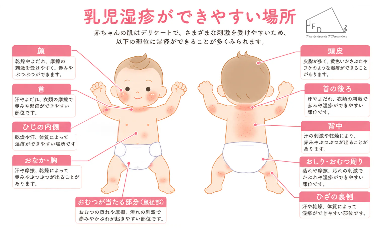 乳児湿疹ができやすい場所の図解