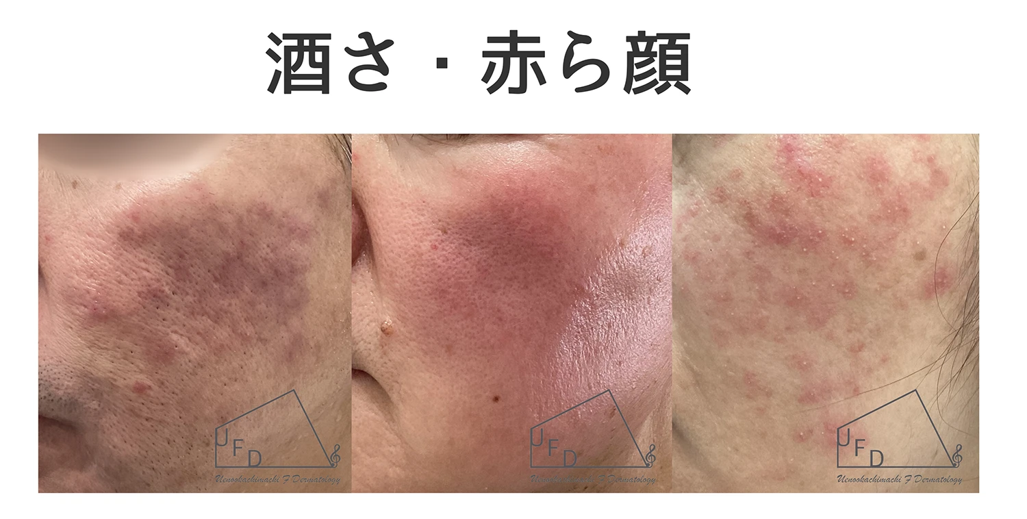 酒さ 赤ら顔の患部写真