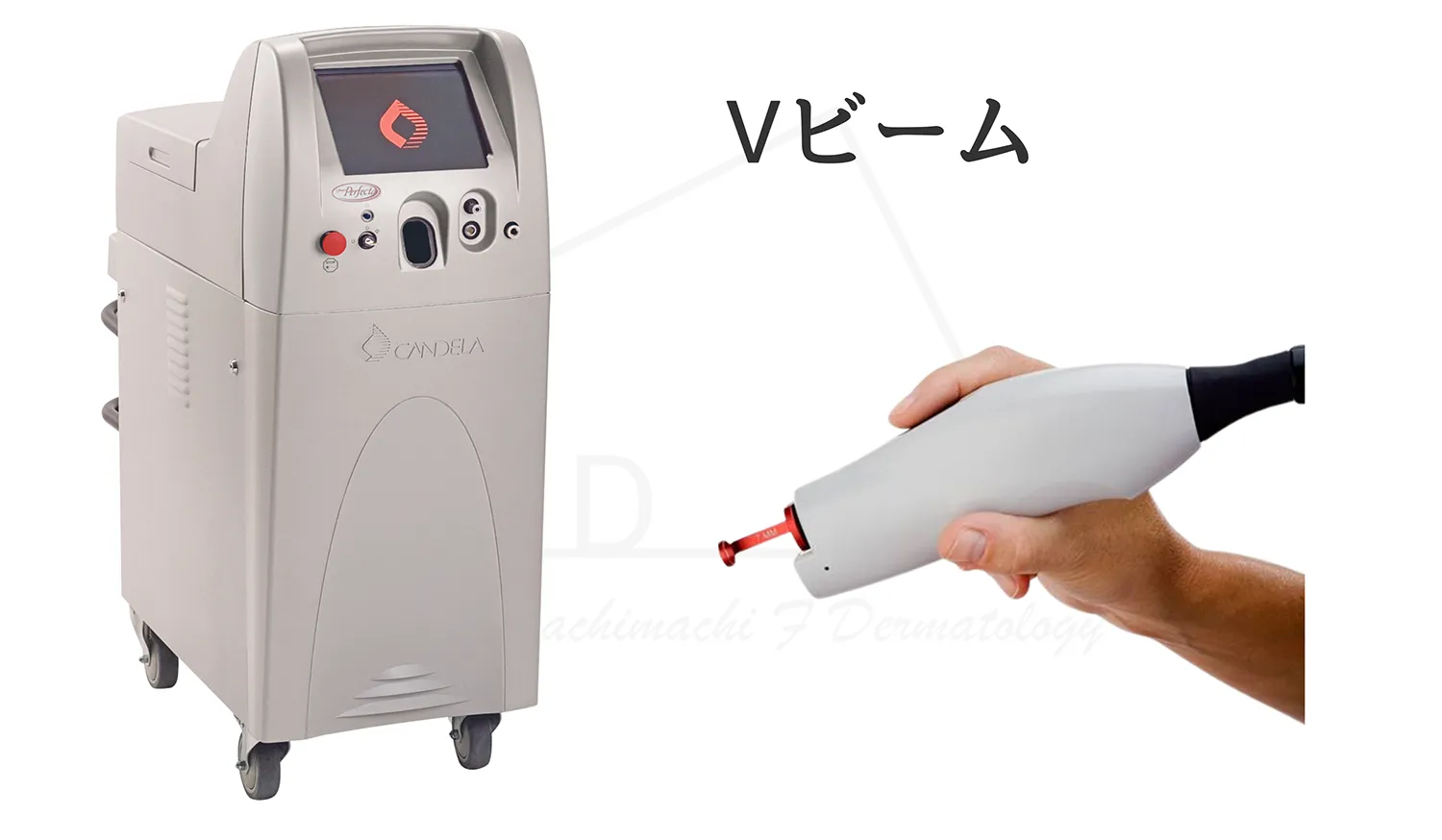 Vビームの画像