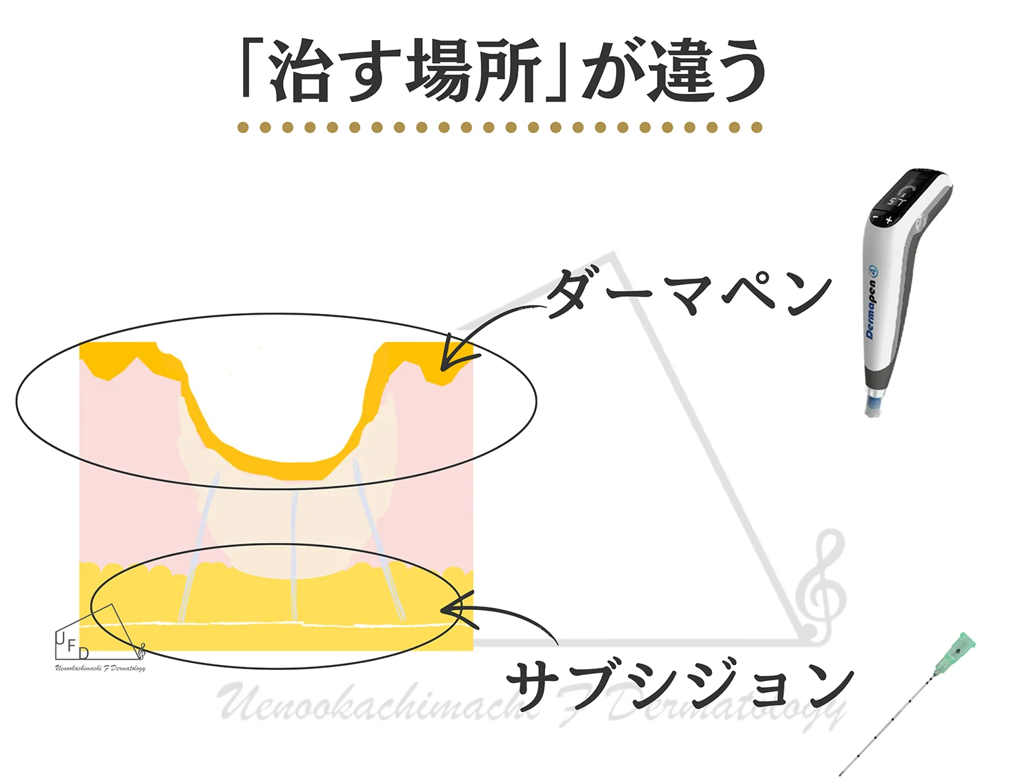 ニキビ跡の断面図。ダーマペンは皮膚の表面側、サブシジョンは皮膚の下の癒着に届くことを示した図