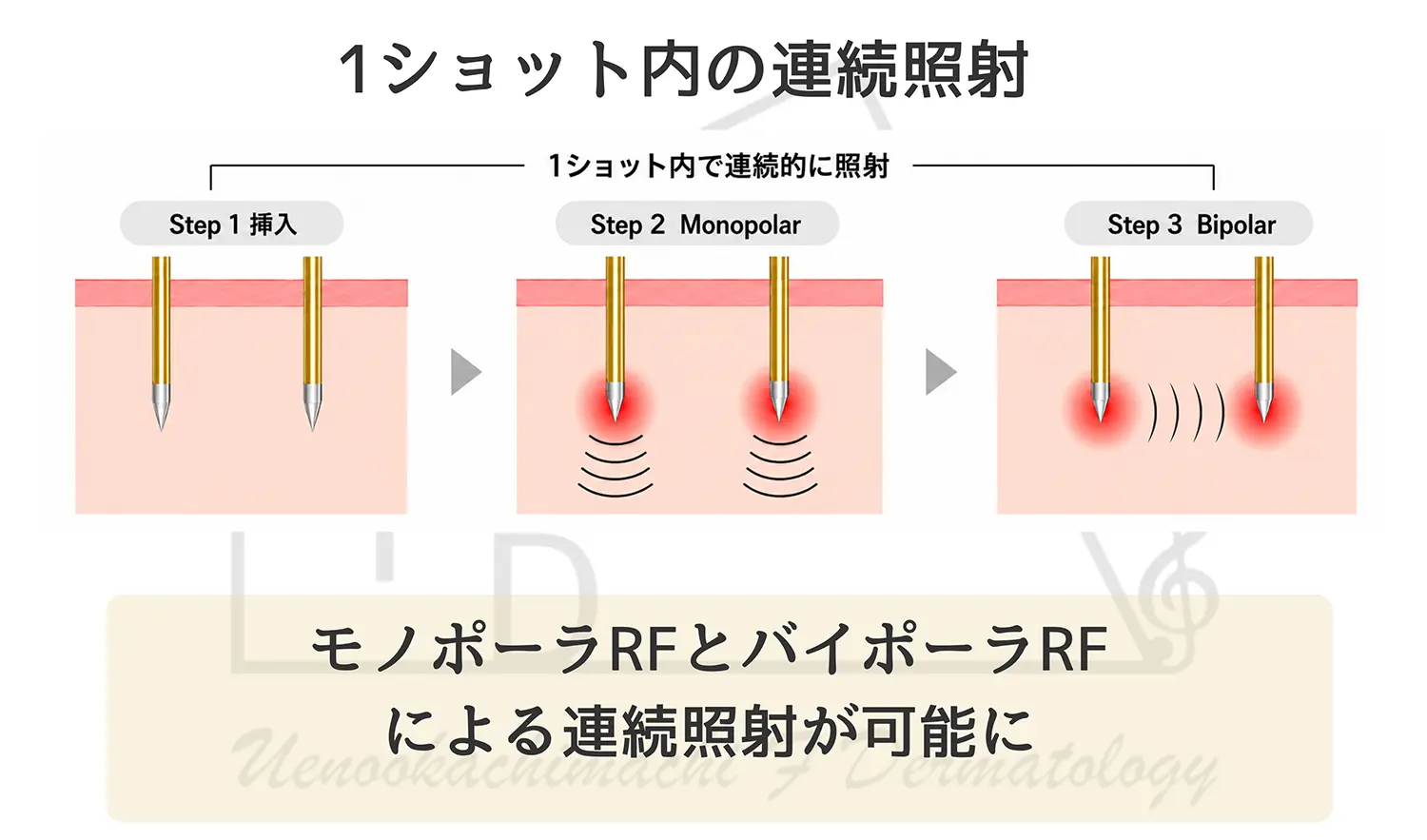 ポテンツァとポテンツァプライムの違い RF照射