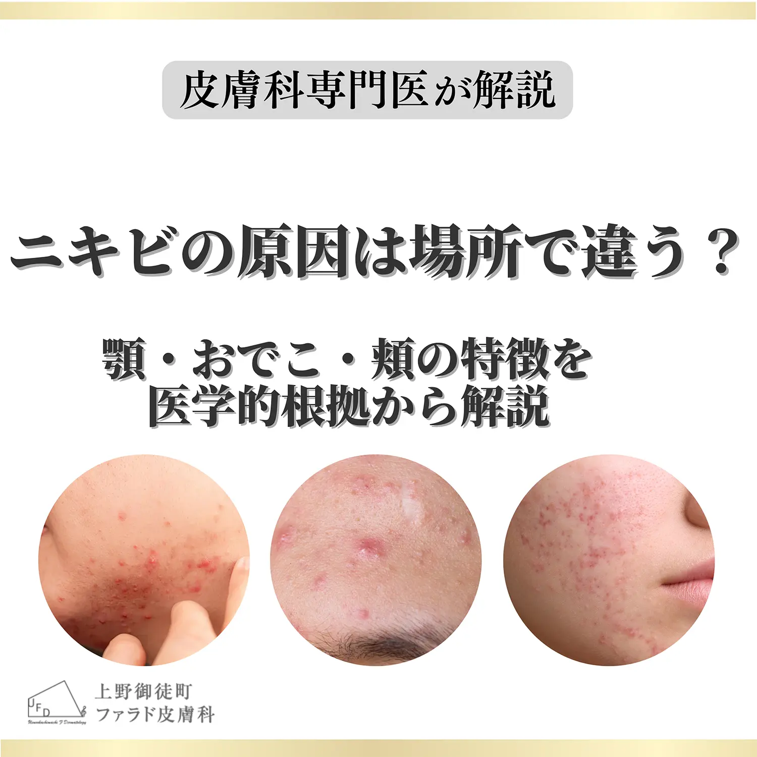 顎・おでこ・頬のニキビを並べた、ニキビの原因は場所で違うかの解説画像
