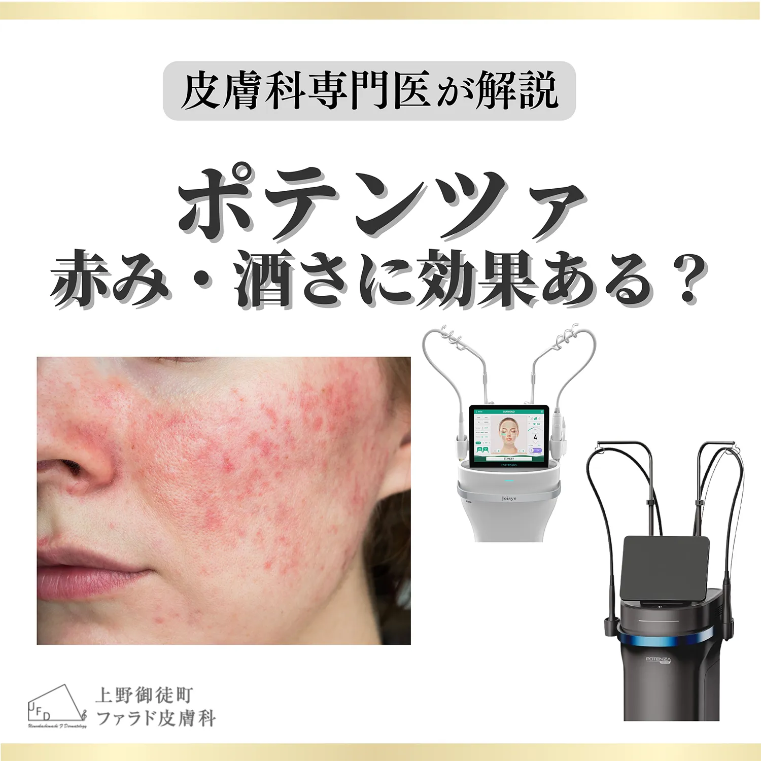 頬の赤みとポテンツァ本体を並べた、ポテンツァは赤み・酒さに効果あるかの解説画像