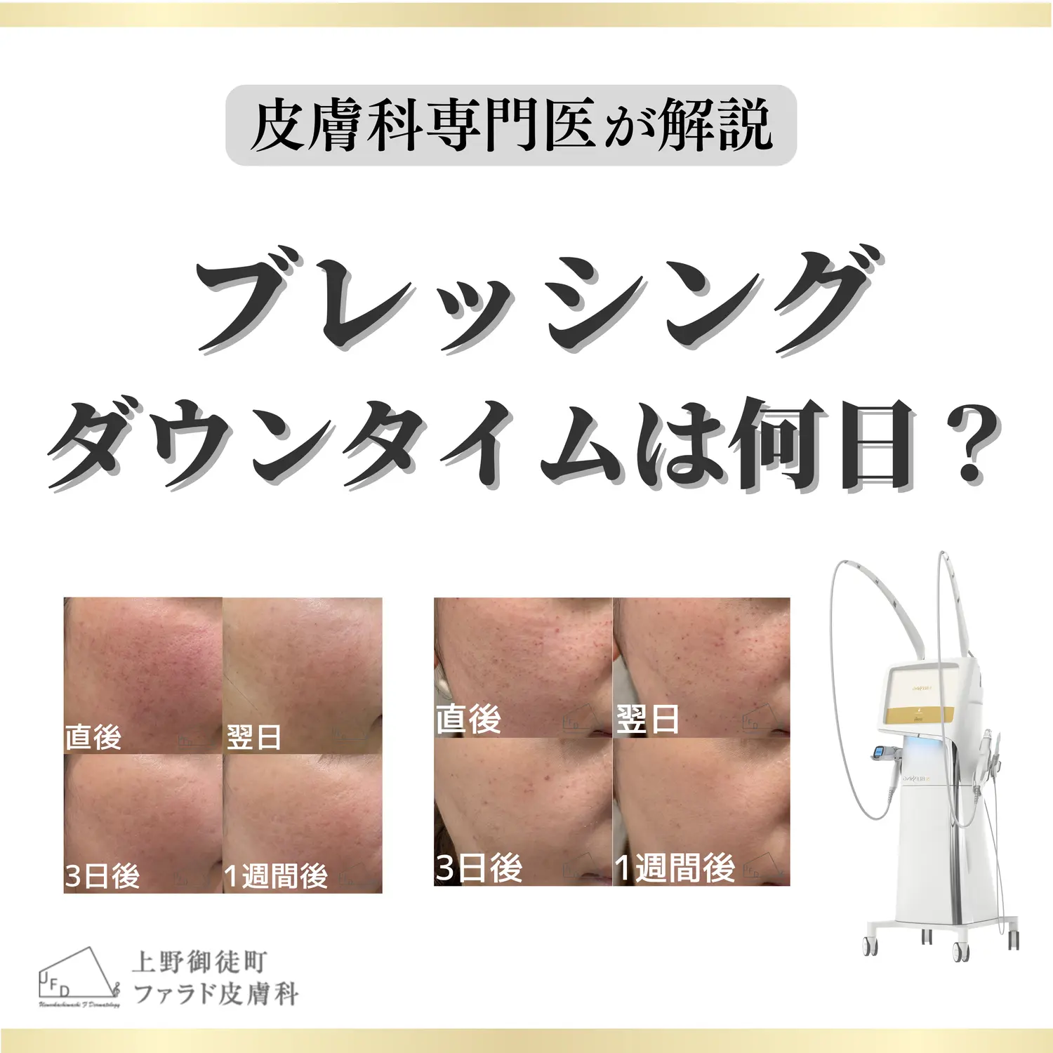 ブレッシングのダウンタイムは何日かを皮膚科専門医が解説するタイトル画像