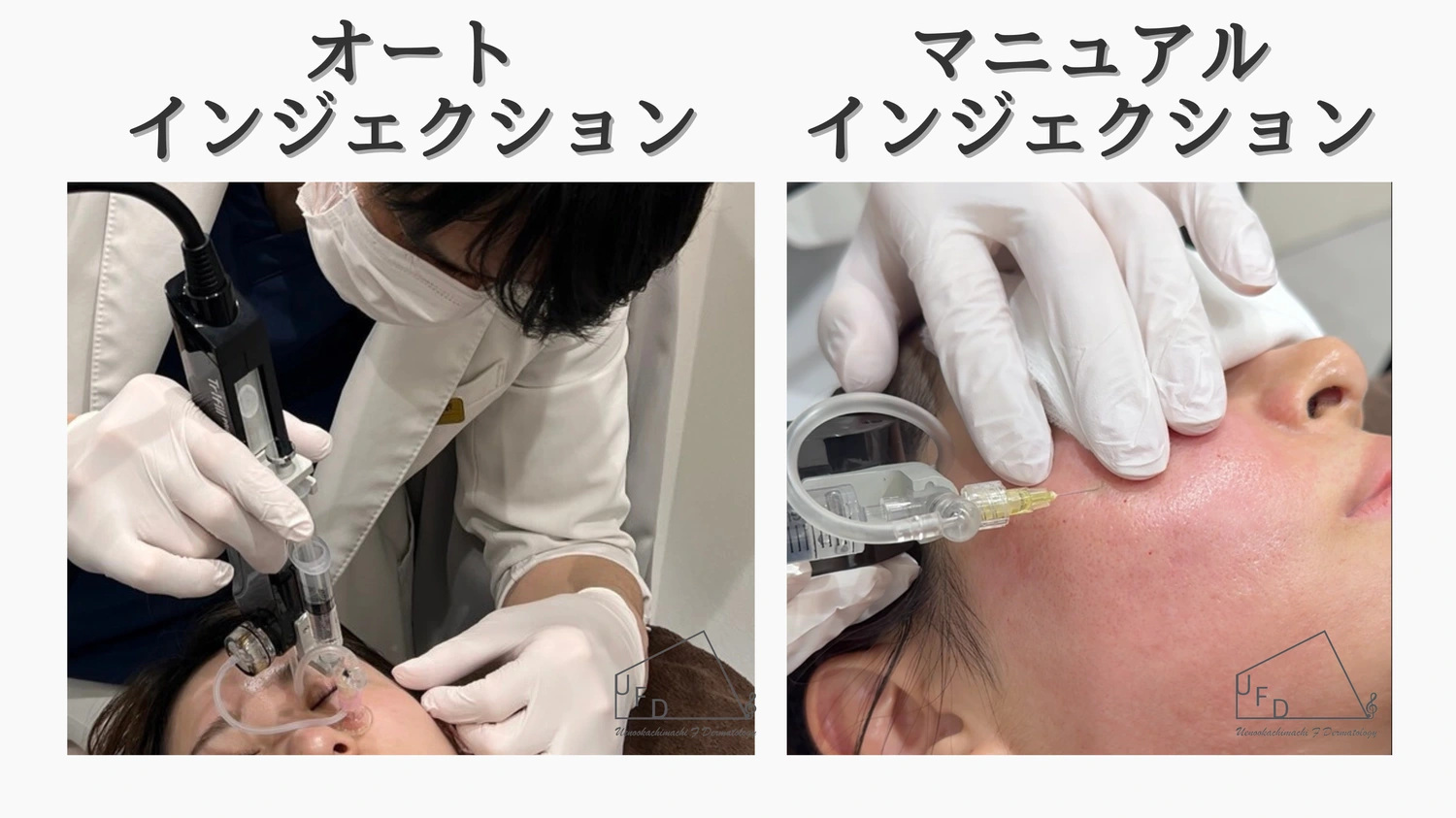 トライフィルプロのオートインジェクションとマニュアルインジェクションの施術の様子