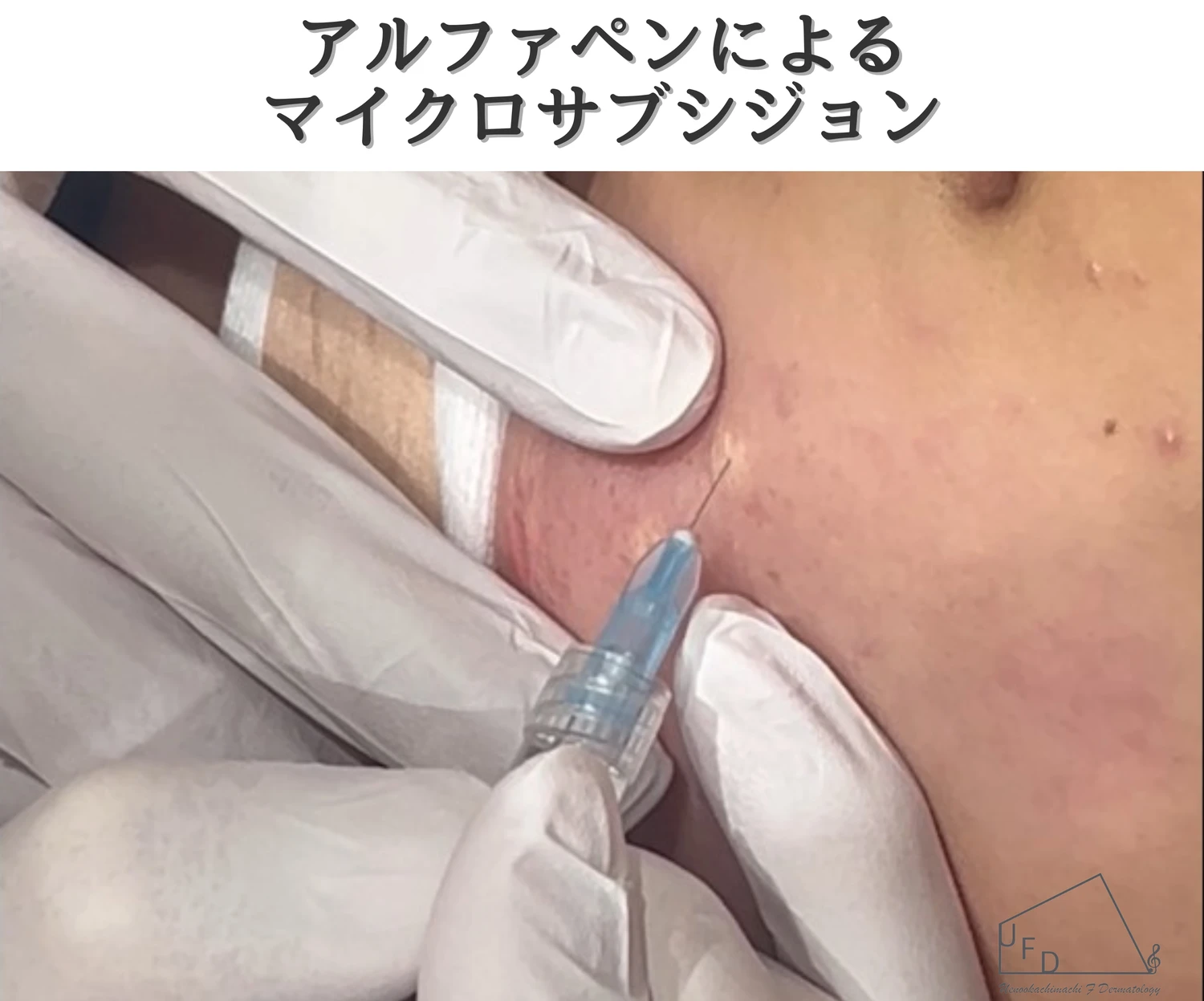 アルファペンによるニキビ跡のマイクロサブシジョンの様子