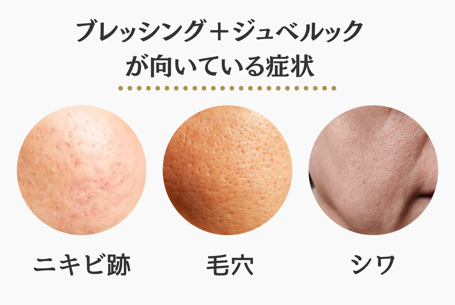 ブレッシング＋ジュベルックが向いているニキビ跡・毛穴・シワ