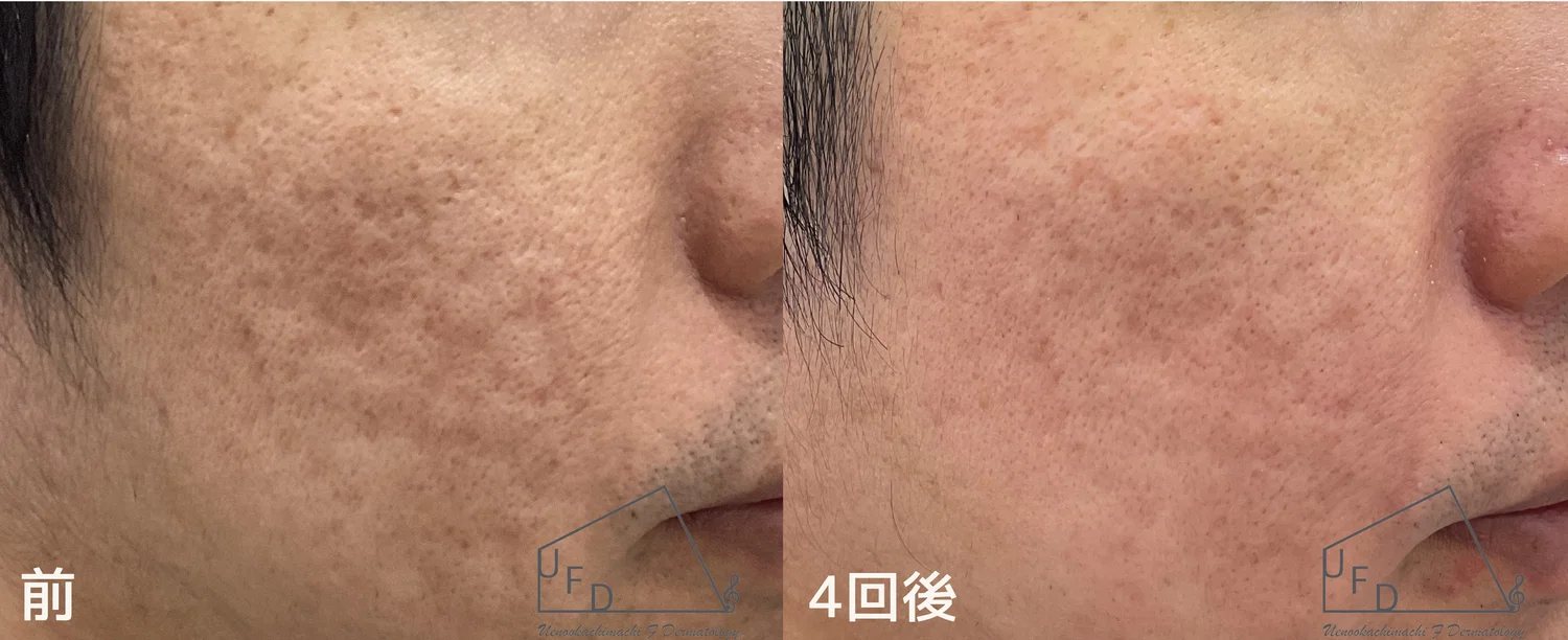 ブレッシング＋ジュベルック4回でニキビ跡が改善した30歳代男性の治療前後