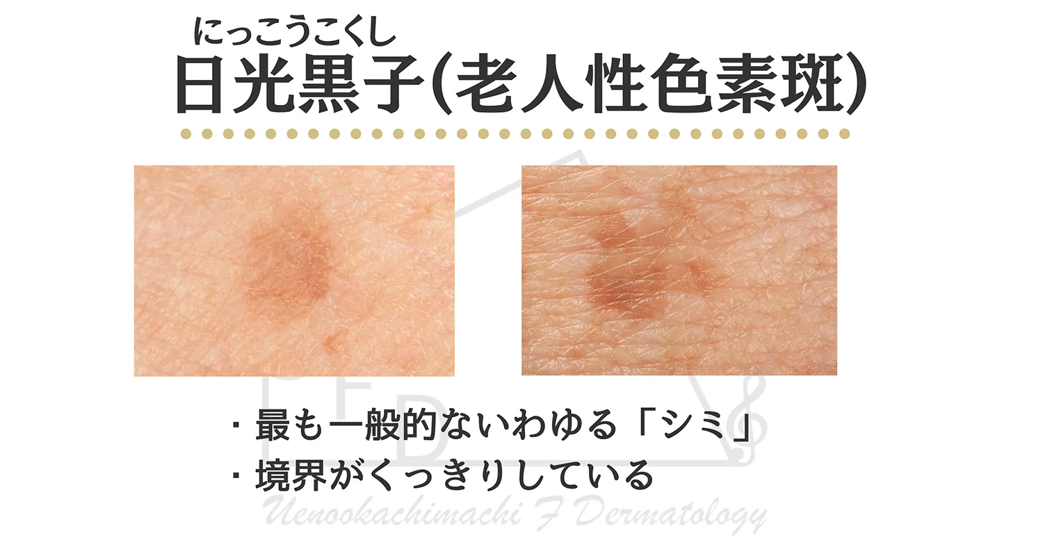 日光黒子の患部写真