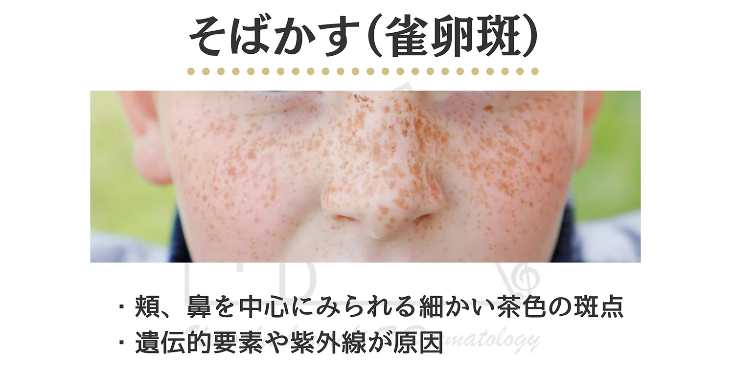 そばかすの患部写真