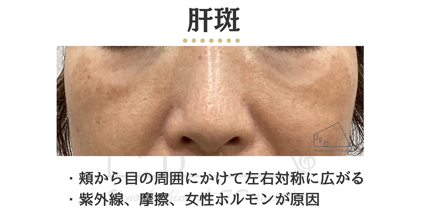 肝斑の患部写真