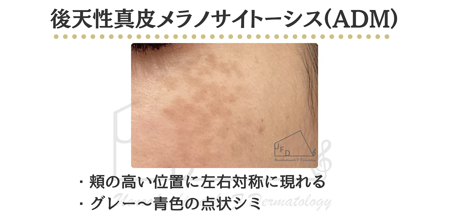 後天性真皮メラノサイトーシス ADMの患部写真