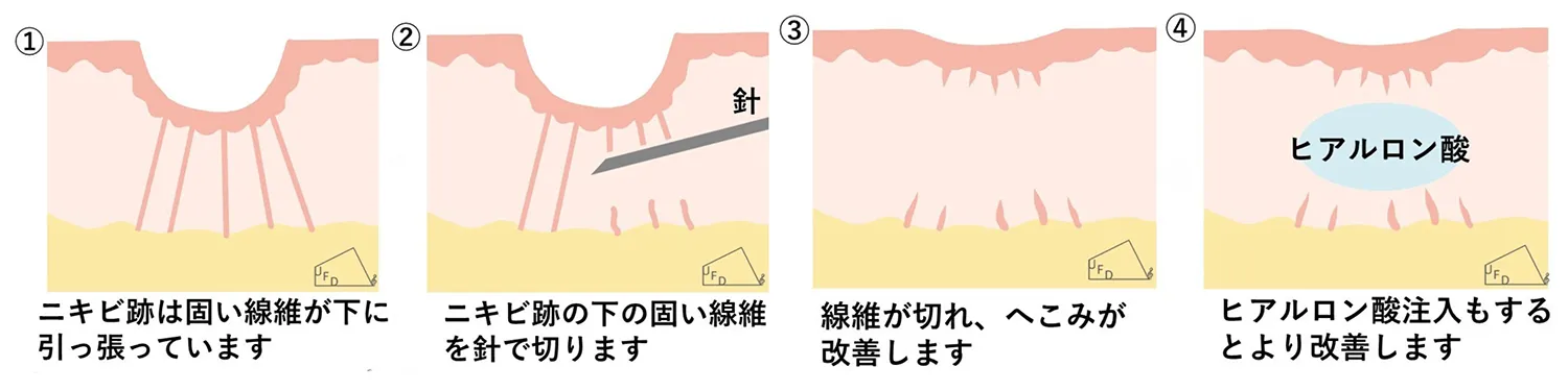 サブシジョンとは？