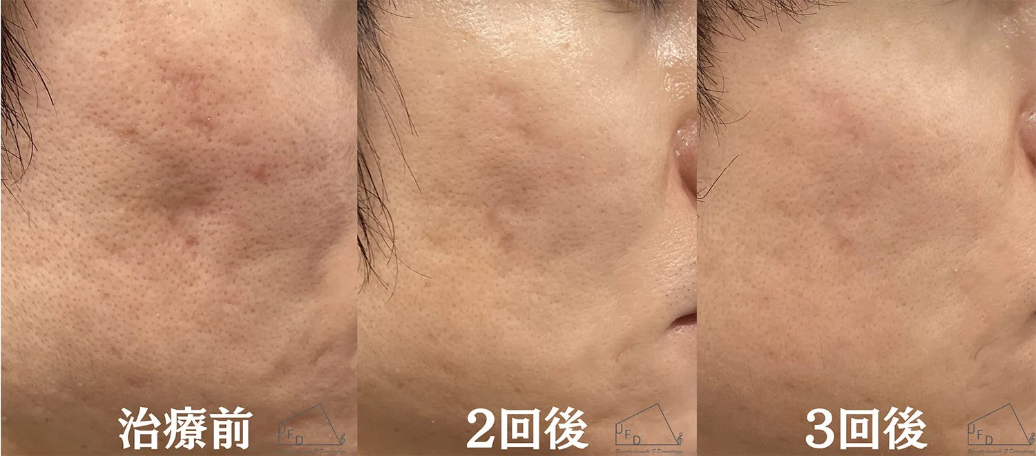 症例１ 【30代男性】頬のニキビ跡（サブシジョン3回施行実施）