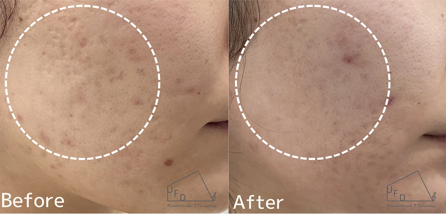 トライフィルプロ症例2