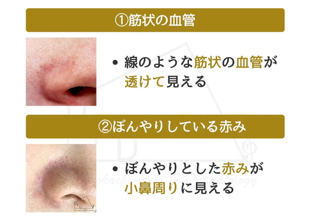小鼻の赤みの種類について説明している画像