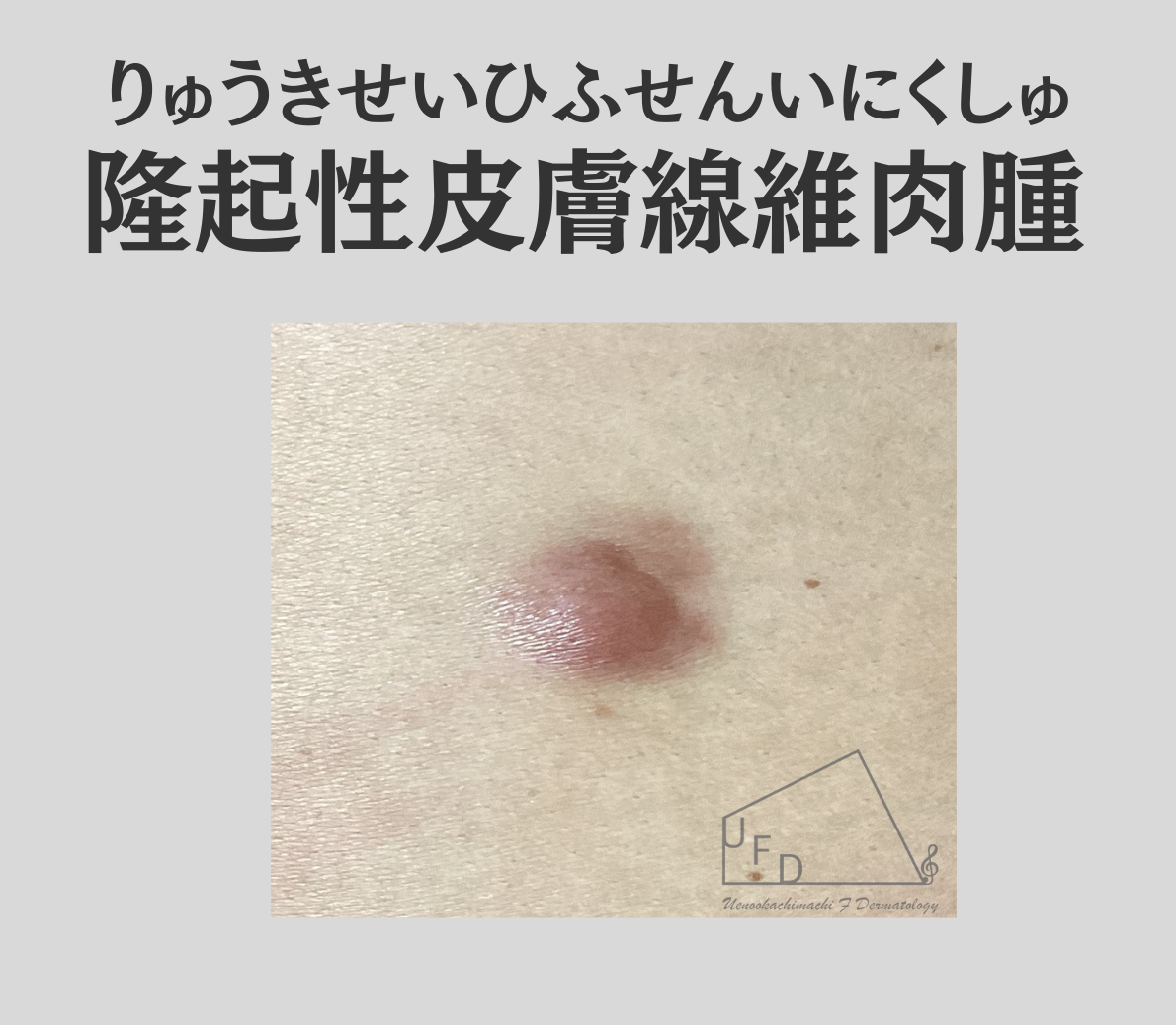 隆起性皮膚線維肉腫(りゅうきせいひふせんいにくしゅ、DFSP: dermatofibrosarcoma protuberans)画像