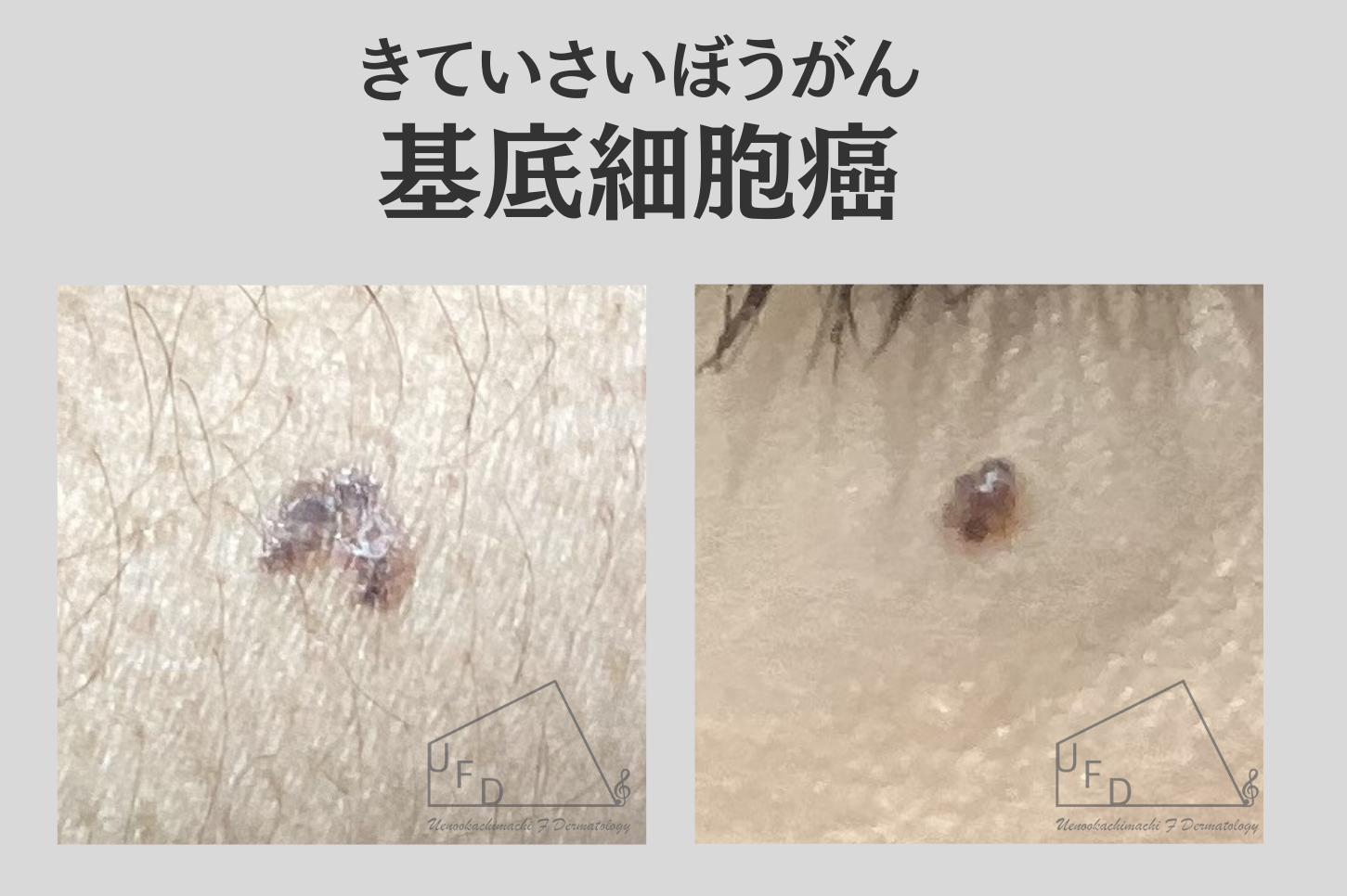 基底細胞癌(きていさいぼうがん、BCC：basal cell carcinoma)画像